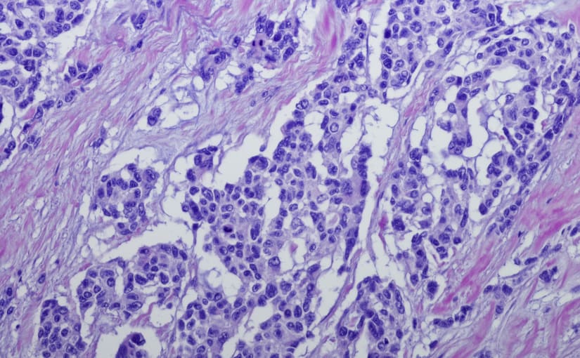 Micrograph of Rhabdomyosarcoma RMS